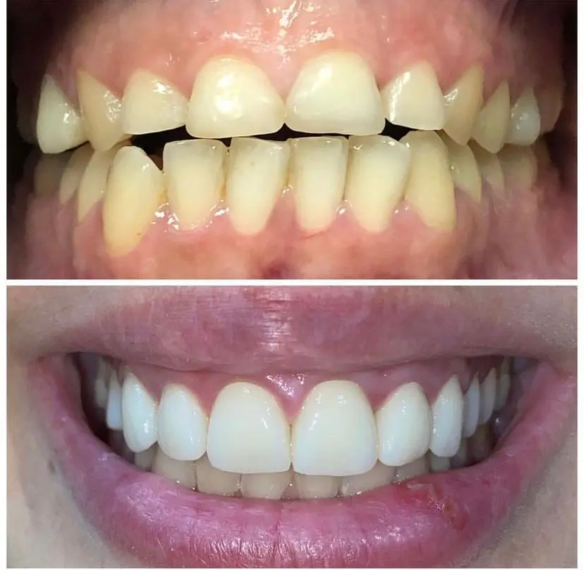 Antes y después de tratamiento dental