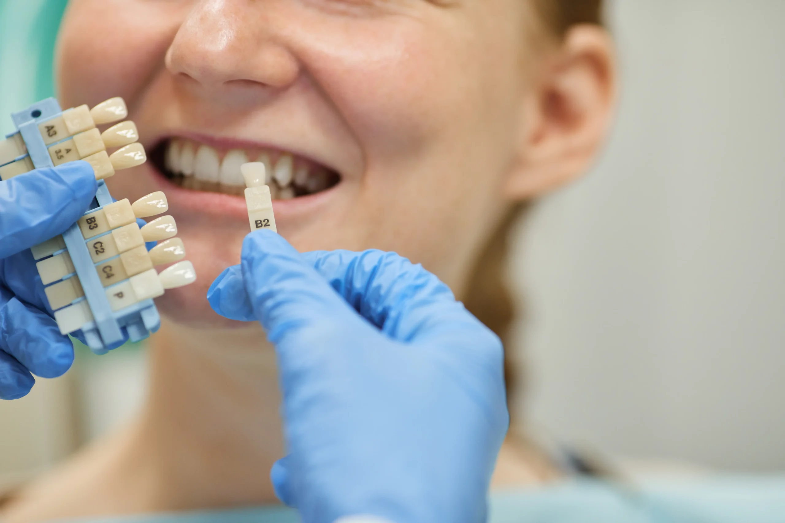 Dentista probando color de esmalte para implante