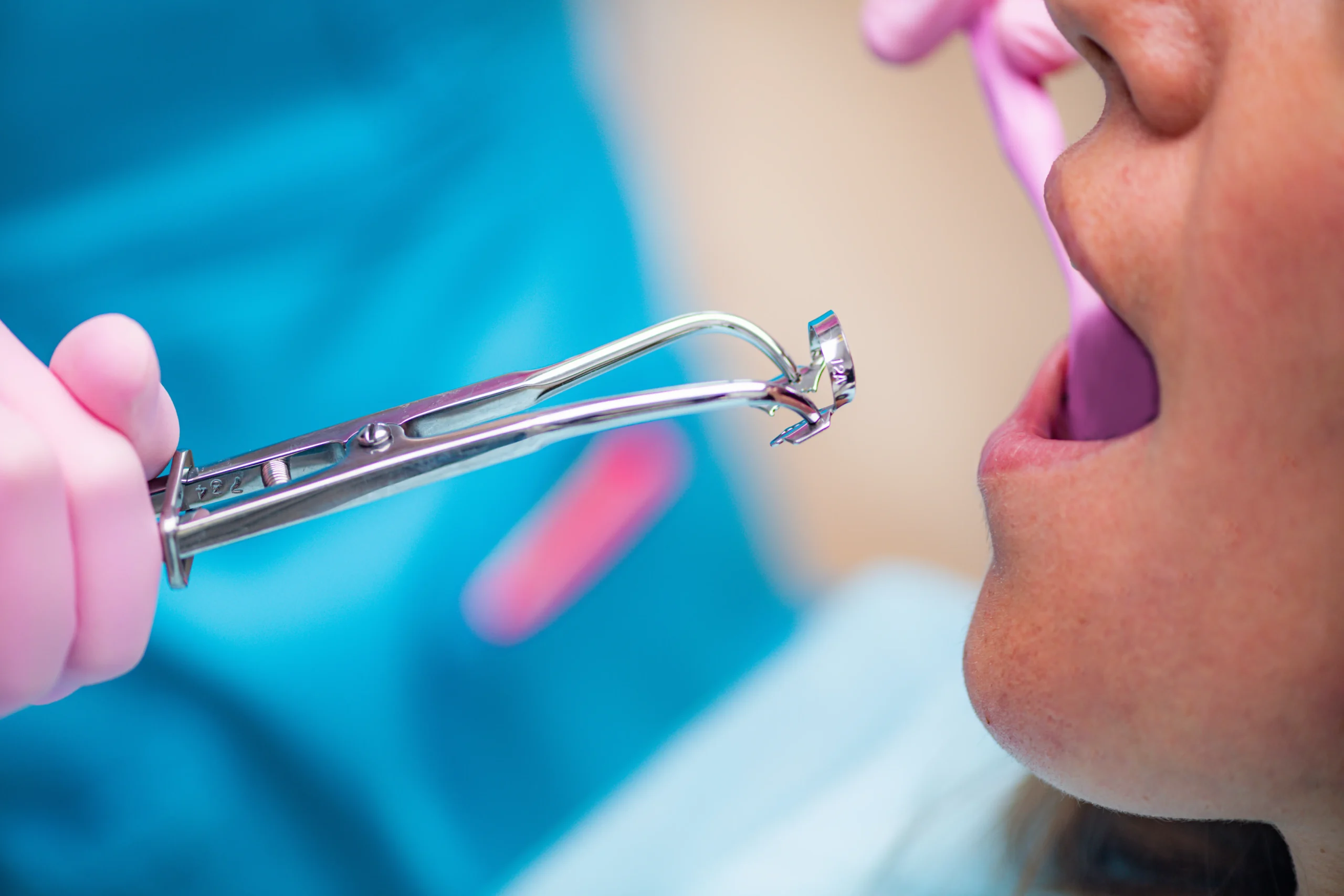 Tratamiento de endodoncia