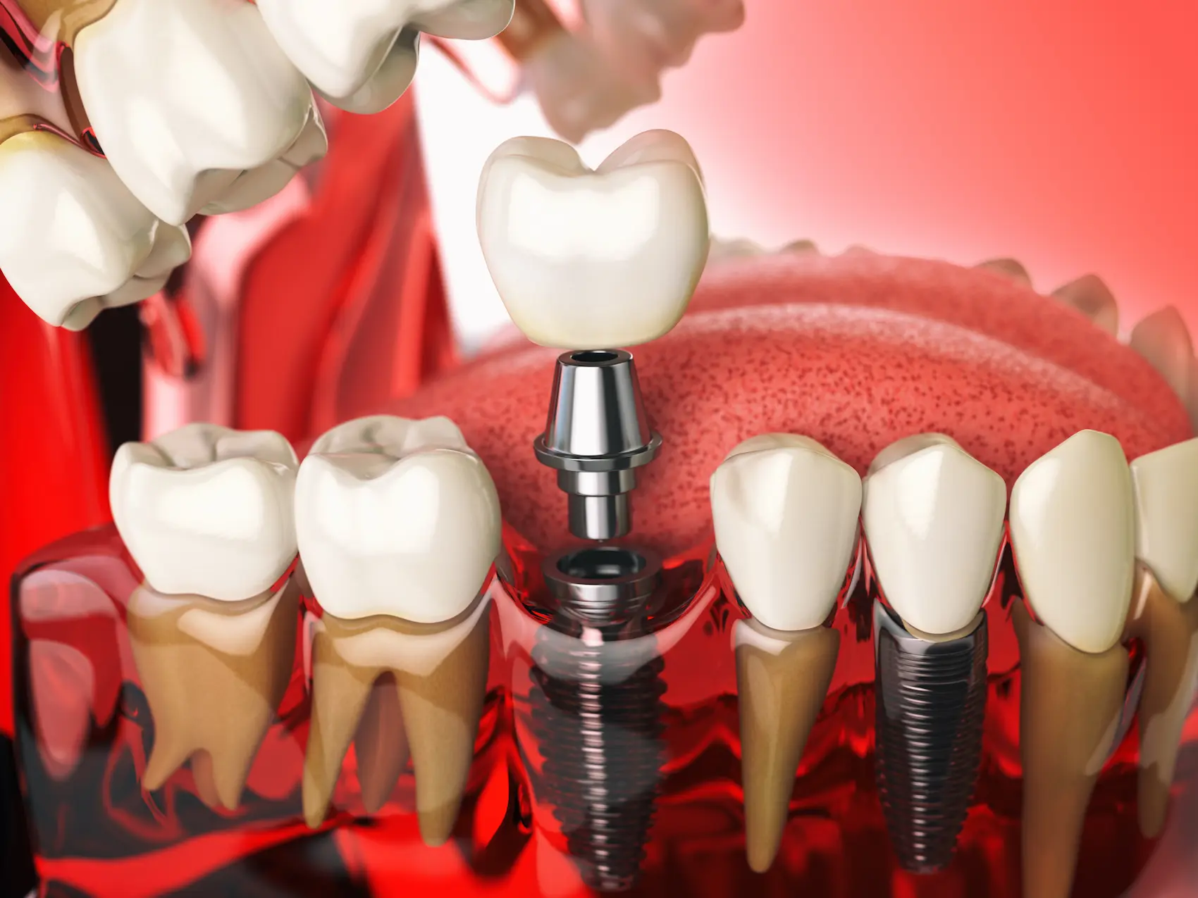 tipos-de-implantes-dentales