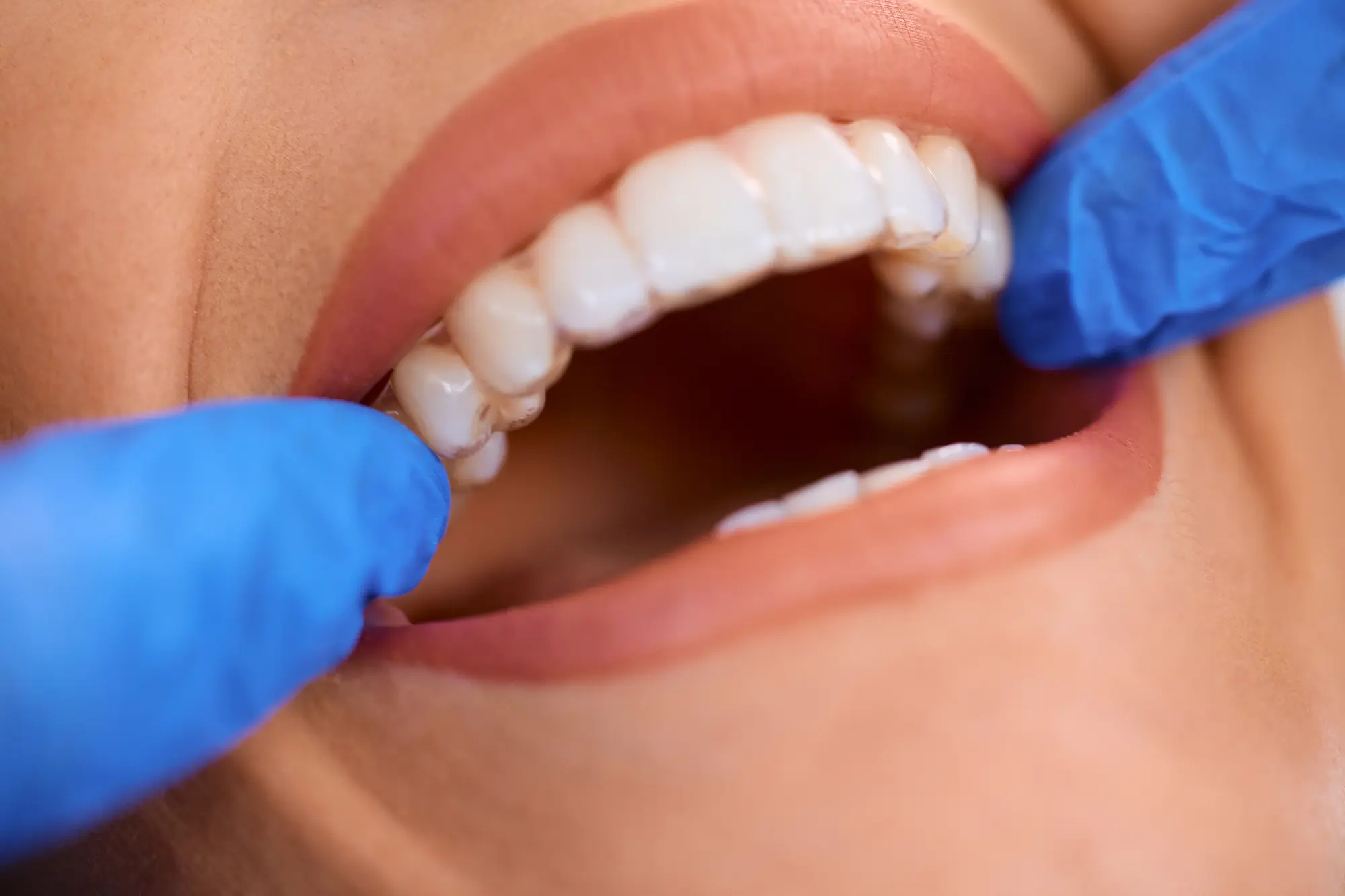 blanqueamiento dental